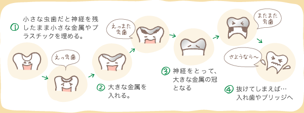 1.小さな虫歯だと神経を残したまま小さな金属やプラスチックを埋める。2.大きな金属を入れる。3.神経をとって、大きな金属の冠となる4.抜けてしまえば… 入れ歯やブリッジへ